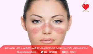 لوپوس چیست؛ علائم بیماری لوپوس در زنان