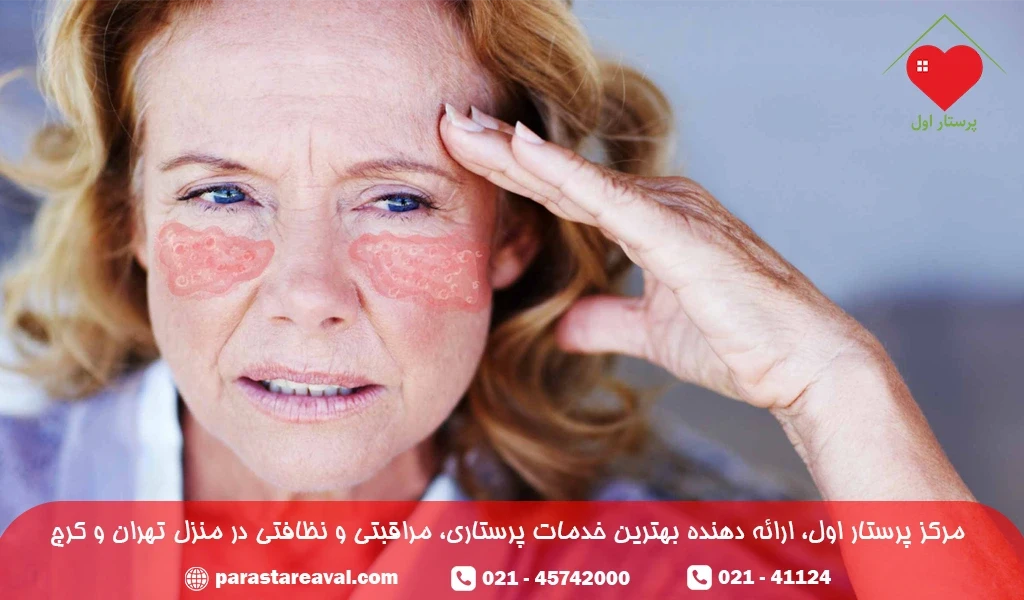 شیمی درمانی بیماری لوپوس