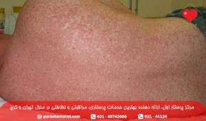 سرخک در بزرگسالان