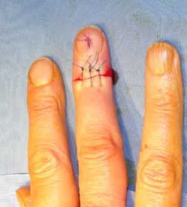 جراحی انگشت چکشی