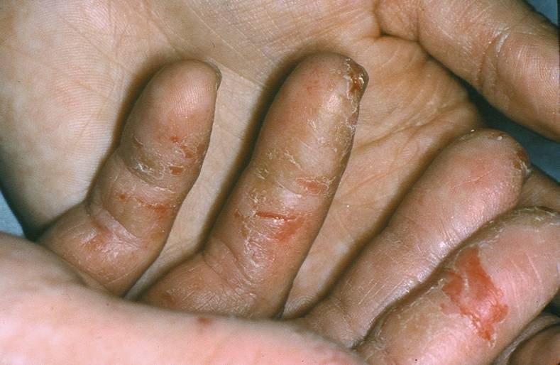 علت بروز بیماری اگزمای دست