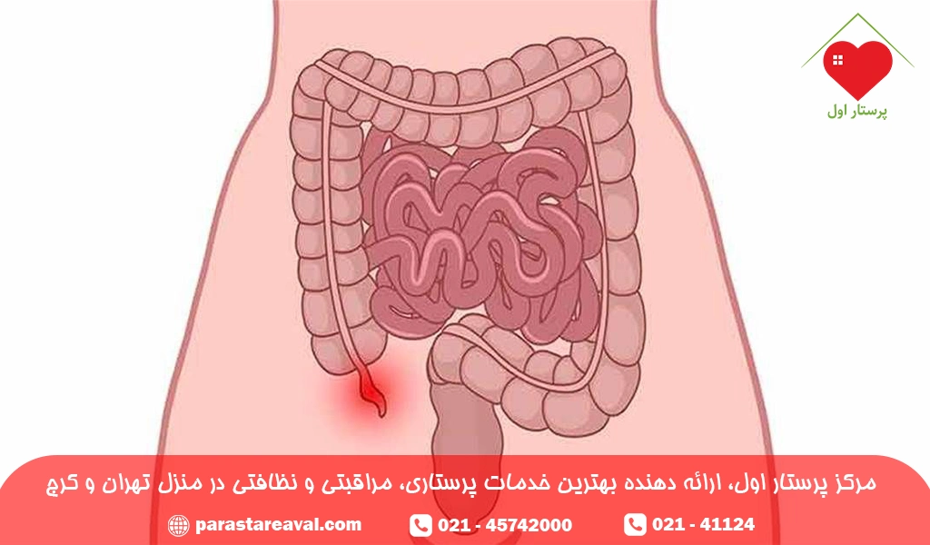 آپاندیسیت بیماری گوارشی
