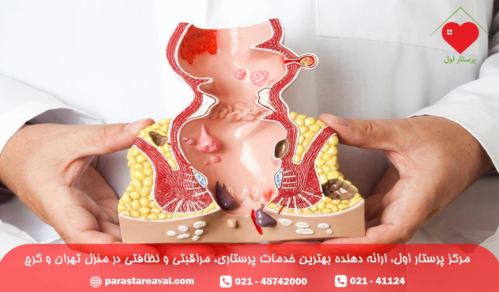 بواسیر یک بیماری گوارشی