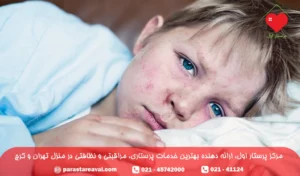 سرخک در کودکان