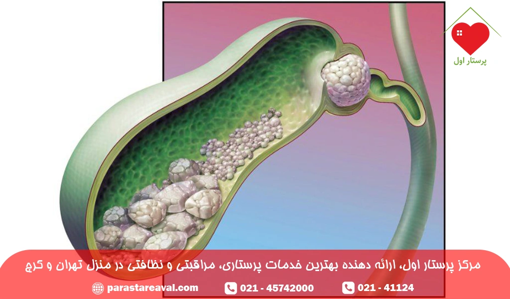 سنگ کیسه صفرا از بیماری های گوارشی