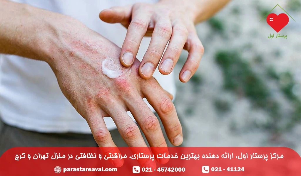 علت اگزمای دست