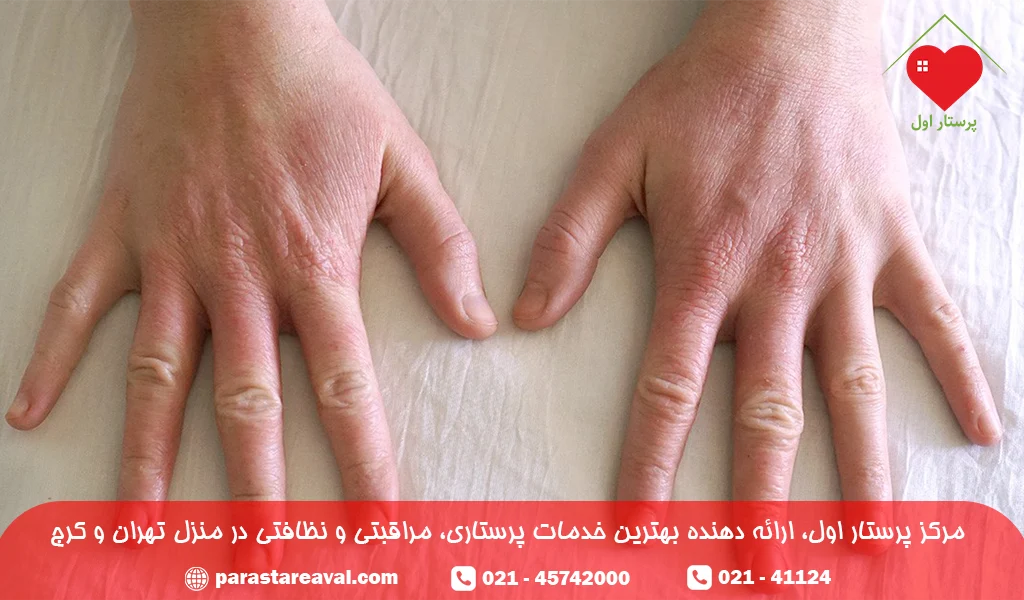عوامل تحریک کننده اگزمای دست