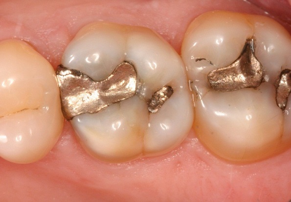 پوسیدگی دندان و روش های درمان آن