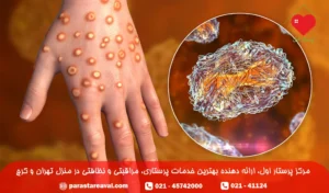 آبله میمونی