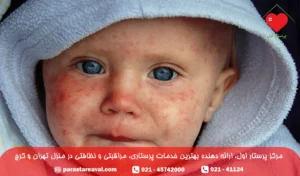 سرخجه در کودکان + تصاویر بیماری سرخجه