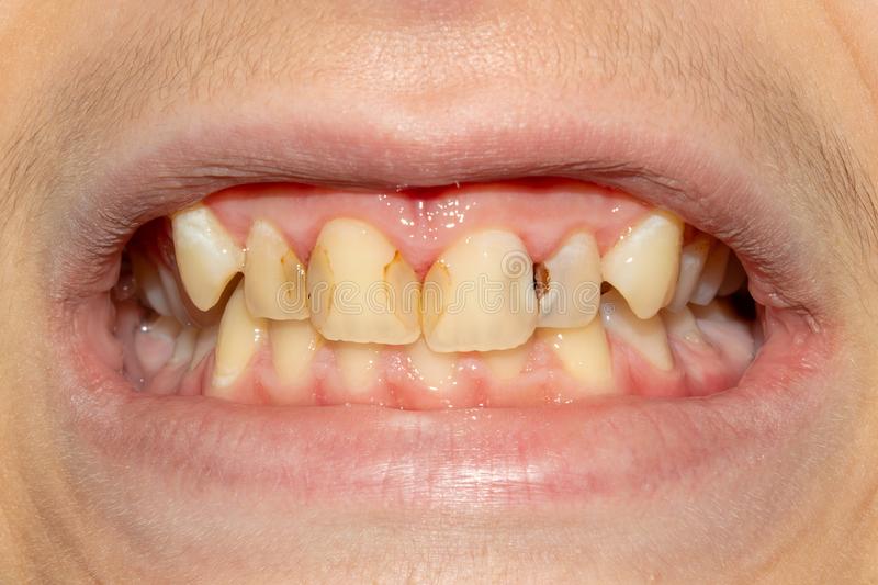 پوسیدگی دندان چگونه رخ می دهد
