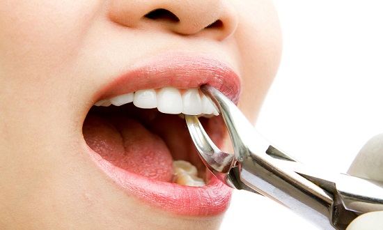 کشیدن دندان بدون جراحی