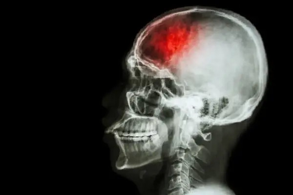 مراقبت از بیمار سکته مغزی چگونه است؟