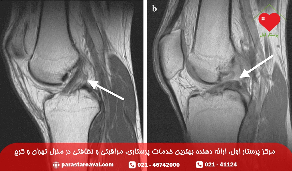 تشخیص پارگی رباط صلیبی