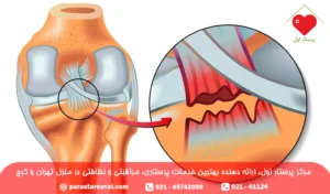 پارگی رباط صلیبی