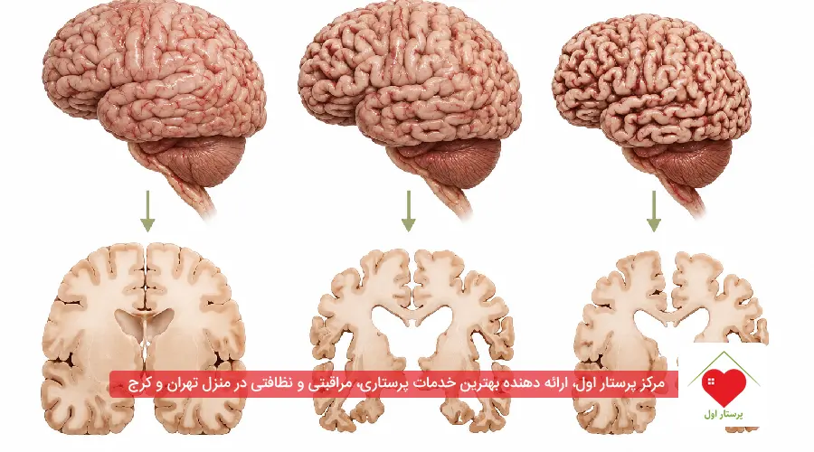 طول عمر بیماران آتروفی مغز