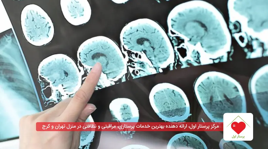 علائم کوچک شدن مغز سالمندان